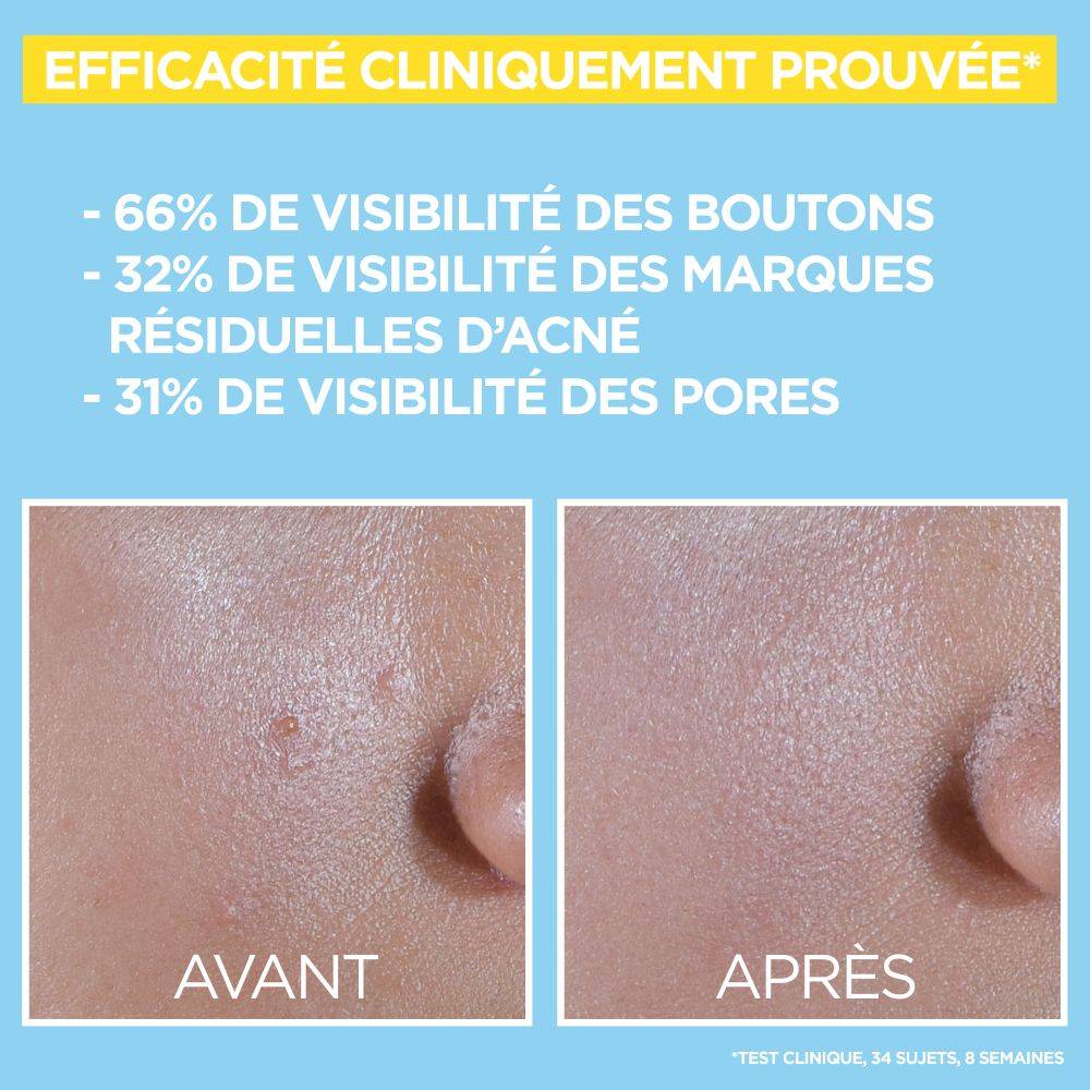 10 2875 GAR pureactive BHA Niacinamide Before After V1