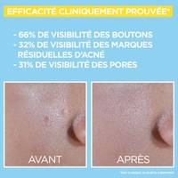 10 2875 GAR pureactive BHA Niacinamide Before After V1